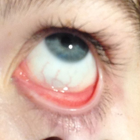 Eine Ader Im Auge Ist Geschwollen Welche Ursache Konnte Das Haben Medizin Augen Warzen Eine Ader Im Auge Ist Geschwollen Welche Ursache Konnte Das Haben Medizin Augen Warzen