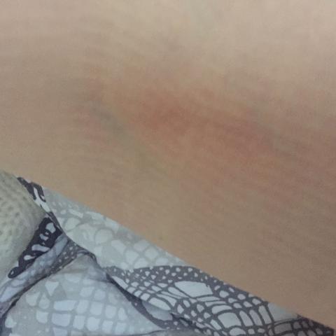 Ader Ist Rot Thrombose Gesundheit Medizin Arzt Ader Ist Rot Thrombose Gesundheit Medizin Arzt