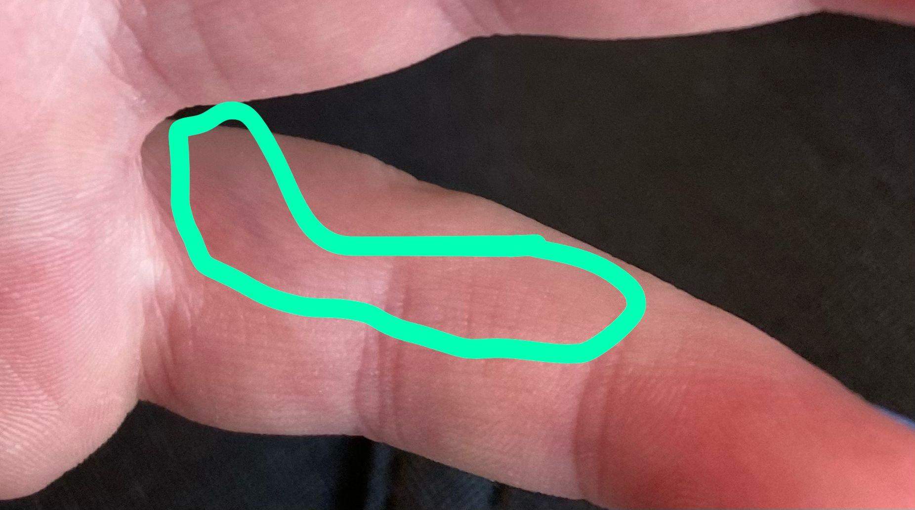 Ader plötzlich an meinem Finger aufgetaucht, fühlt sich taub an und pulsiert? (Gesundheit und Ader plötzlich an meinem Finger aufgetaucht, fühlt sich taub an und pulsiert? (Gesundheit und