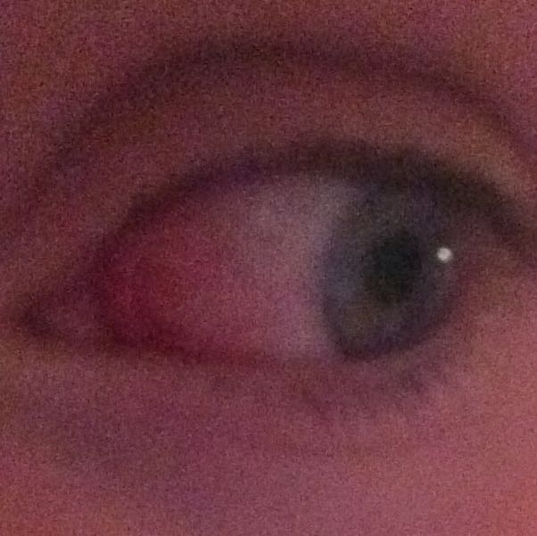 Adern im Auge geplatzt, muss ich zum Arzt? (Augen, rot)