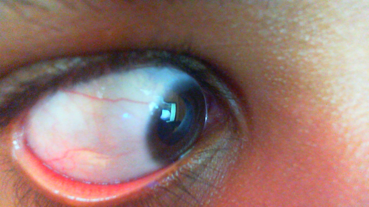 Adern im Auge Kontaktlinsen (Medizin, Augen, Pflege)