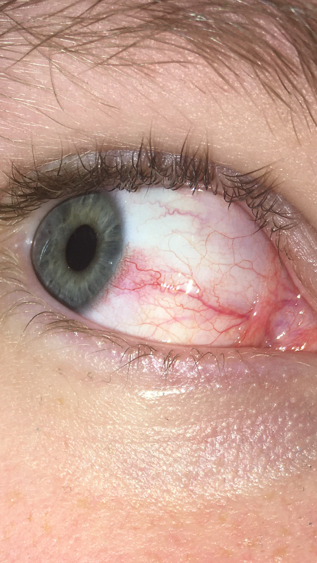Adern Im Auge Sichtbar Gefahrlich Gesundheit Und Medizin Augen Adern Im Auge Sichtbar Gefahrlich Gesundheit Und Medizin Augen