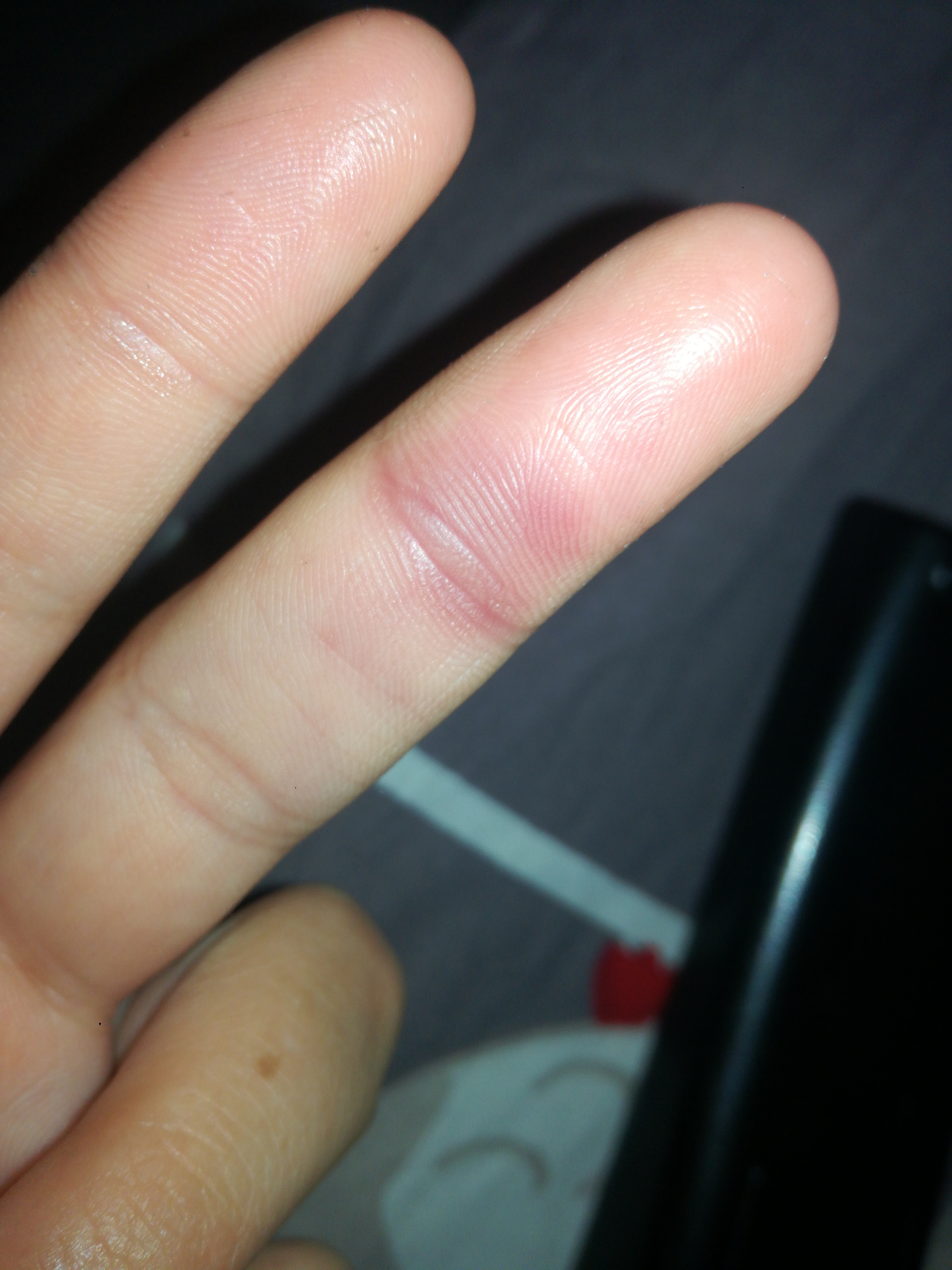 Adern Im Mittelfinger Dick Was Kann Das Sein Finger Blutgefass Adern Im Mittelfinger Dick Was Kann Das Sein Finger Blutgefass