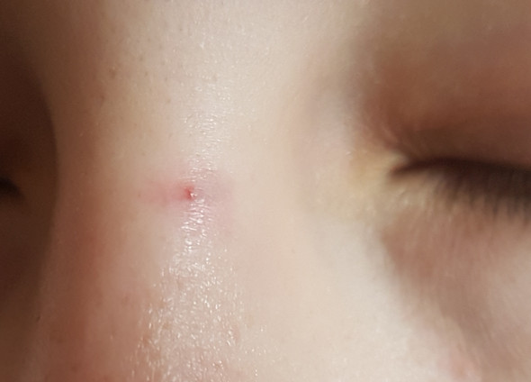 Aderchen Geplatzt Wie Bekomme Ich Das Weg Gesundheit Hautprobleme Aderchen Geplatzt Wie Bekomme Ich Das Weg Gesundheit Hautprobleme