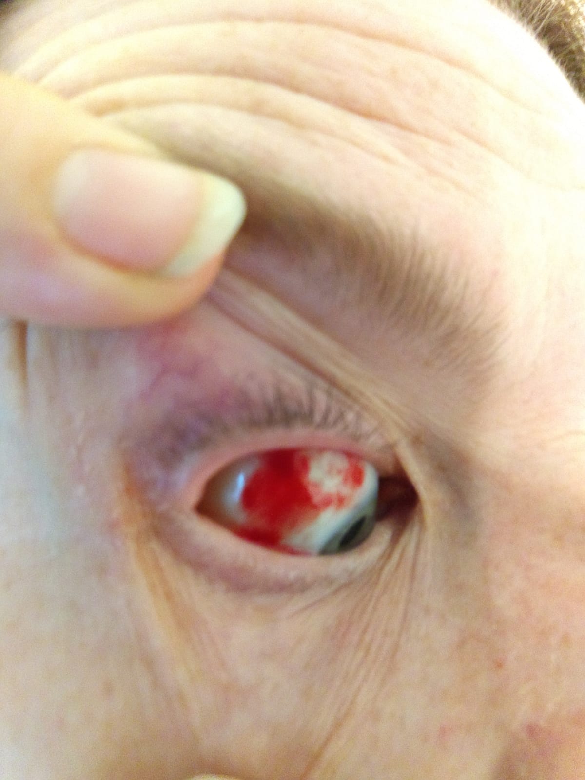 Ader Im Augenlid Geplatzt : Ader im Auge geplatzt - Wie kommt es dazu