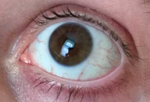 Aderchen Im Auge Wie Gefahrlich Sind Diese Mit Bildern Augen Aderchen Aderchen Im Auge Wie Gefahrlich Sind Diese Mit Bildern Augen Aderchen