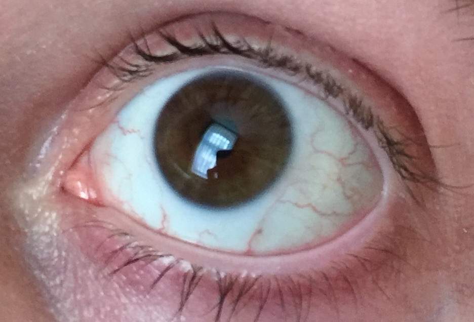Rote äderchen Im Auge Wegbekommen Captions Trending Update Rote äderchen Im Auge Wegbekommen Captions Trending Update