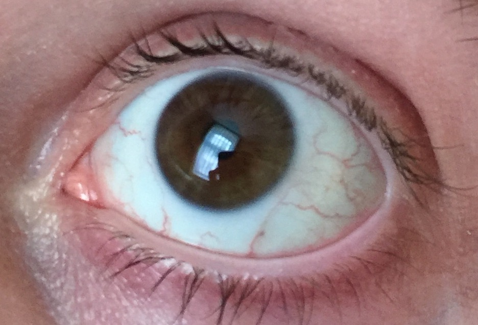 Platzen Von Adern Im Auge www.gutefrage.net