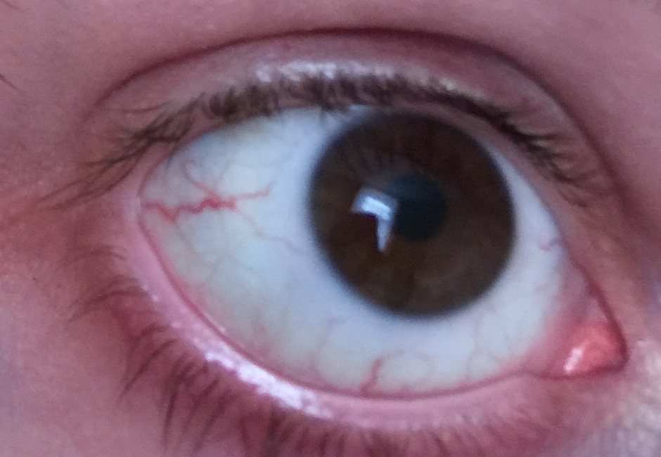 Äderchen im Auge? Wie gefährlich sind diese? (mit Bildern)? (Augen, äderchen) Äderchen im Auge? Wie gefährlich sind diese? (mit Bildern)? (Augen, äderchen)