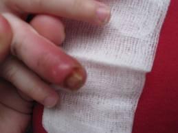 Der Finger meiner Schwester - (Kinder, Entzündung)