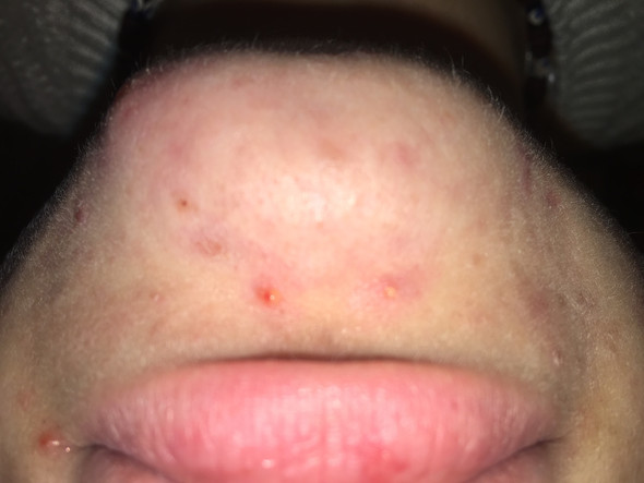 Akne / Pickel narben am kinn und geht nicjt weg? (Angst, Haut, Blut) pickel am kinn wegbekommen