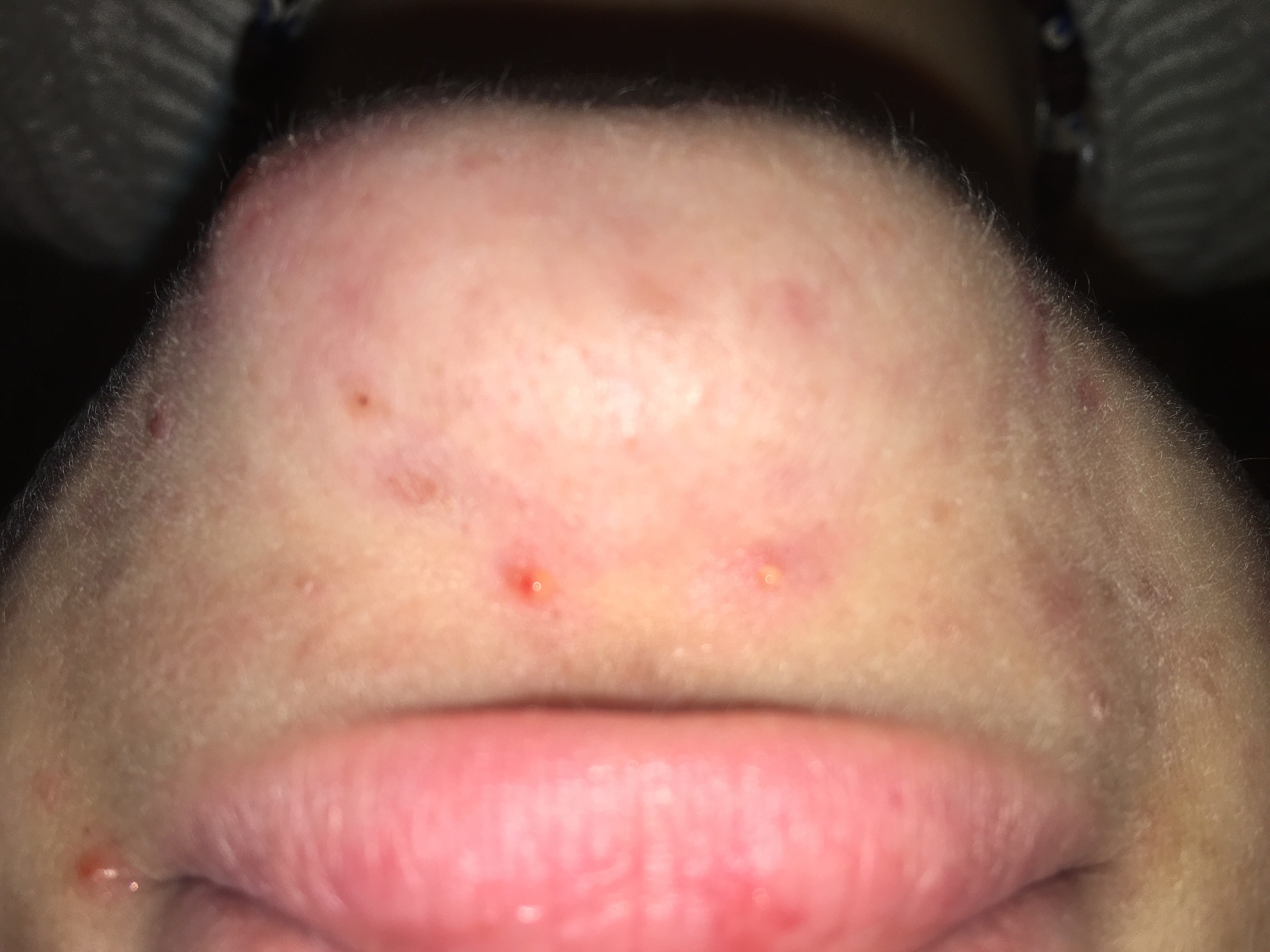 Akne / Pickel narben am kinn und geht nicjt weg? (Angst, Haut, Blut) pickel auf kinn