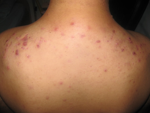 Akne Am Rucken Kann Ich Mich Zum Schwimmbad Trauen Freizeit Bad