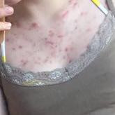 Akne Auf Dekollete Was Tun Pille Hautarzt