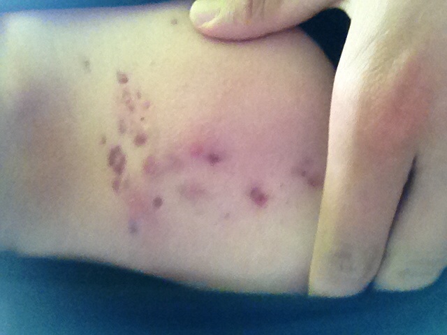 Akne auf der Brust? (Krankheit, Pickel) Akne auf der Brust? (Krankheit, Pickel)