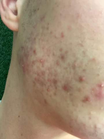 Akne auf der Wange was tun? (Pickel) pickel an der wange ursache