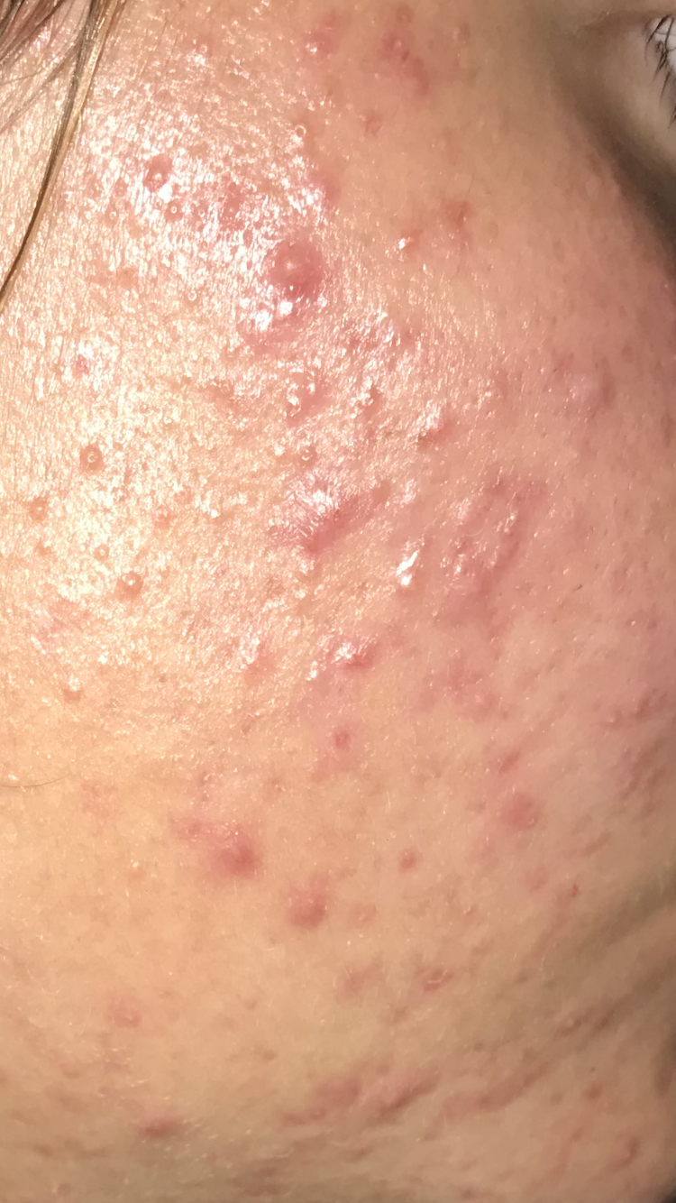 Akne auf Wange stark? (Gesundheit und Medizin, Pickel) pickel auf der wange loswerden