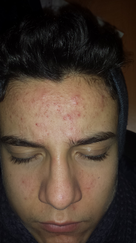 Akne Ich Brauche Hilfe Bild Akne Ich Brauche Hilfe Bild