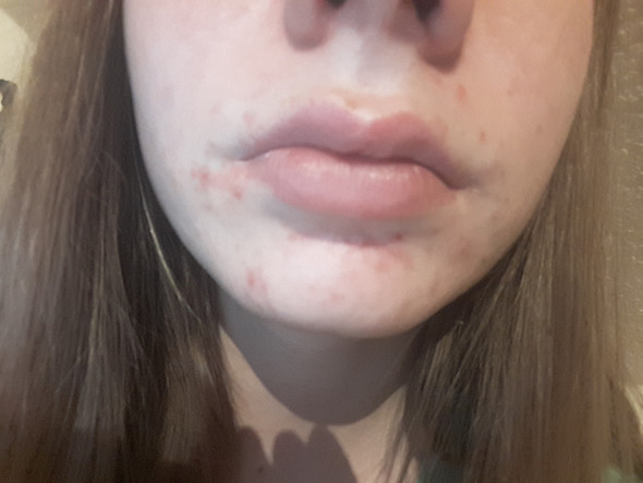 Akne Von Maske Arzt Haut Pickel