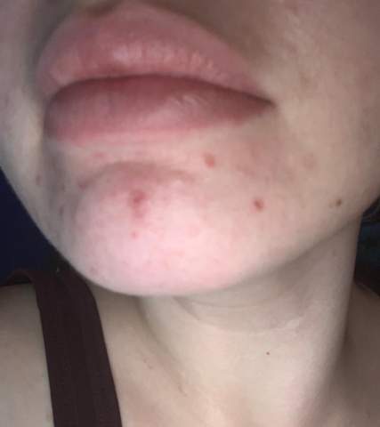 Aknenarben Entfernen Narben Narbenbehandlung Pickelnarben