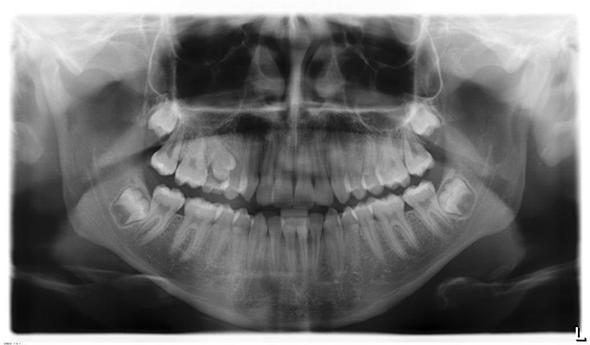 Röntgenbild - (Zähne, Operation, Weisheitszähne)