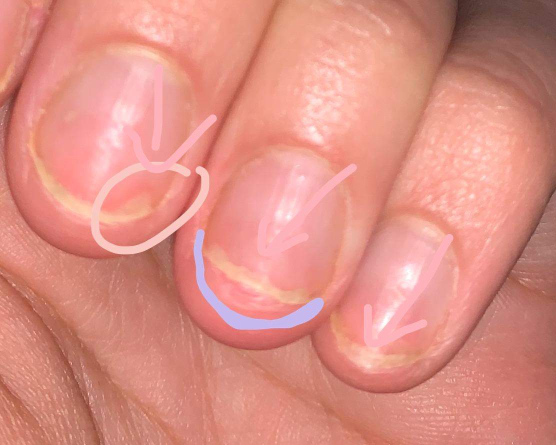 Alle Nägel lösen sich vom Nagelbett langsam ab? (Gesundheit und Medizin, Fingernägel) Alle Nägel lösen sich vom Nagelbett langsam ab? (Gesundheit und Medizin, Fingernägel)