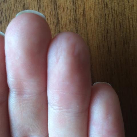 Finger mit Rissen - (Gesundheit, Allergie, Finger)