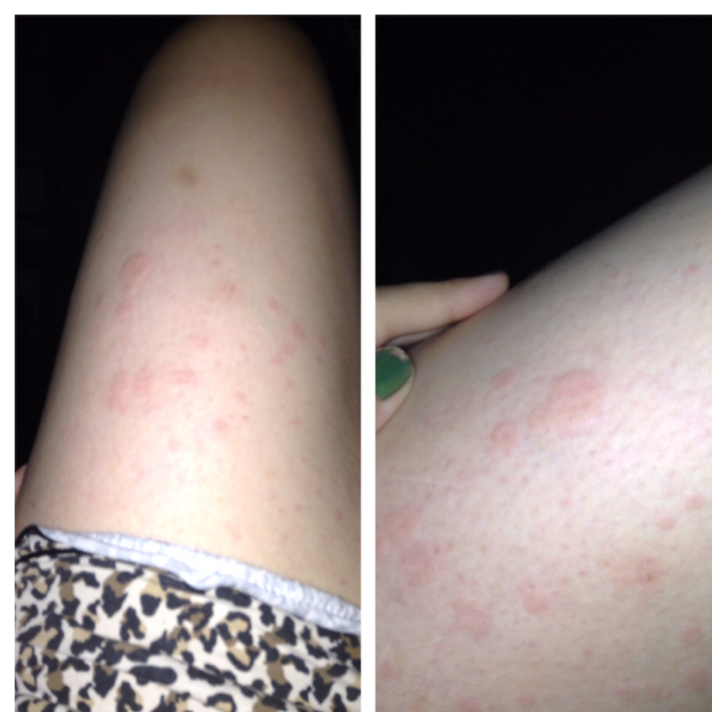 Allergie? Krankheit? Was ist das? Hilfe! (krank, rot, Pusteln) Allergie? Krankheit? Was ist das? Hilfe! (krank, rot, Pusteln)