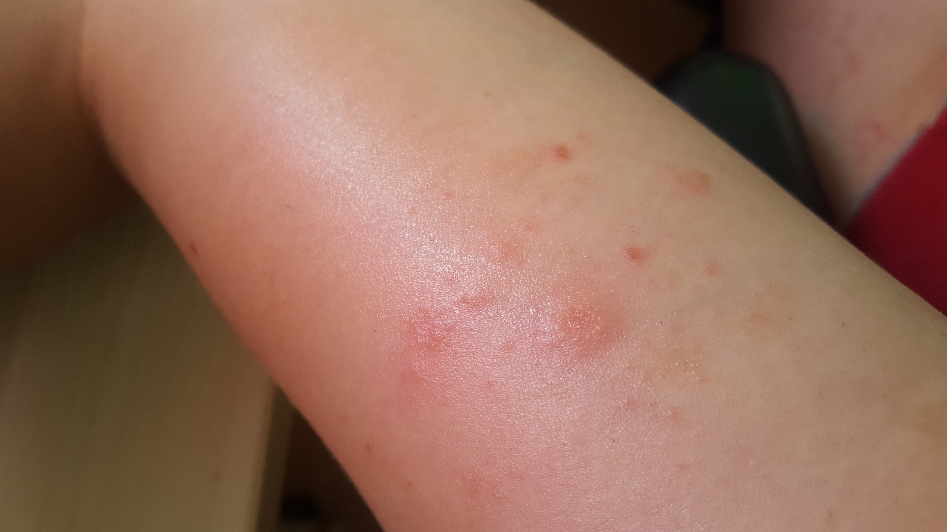 Allergie oder Hautpilz? (Gesundheit und Medizin, Hautarzt, Hautprobleme)