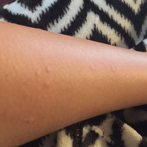 Allergische Reaktion Nach Waxen An Den Armen Medizin Beauty Haut