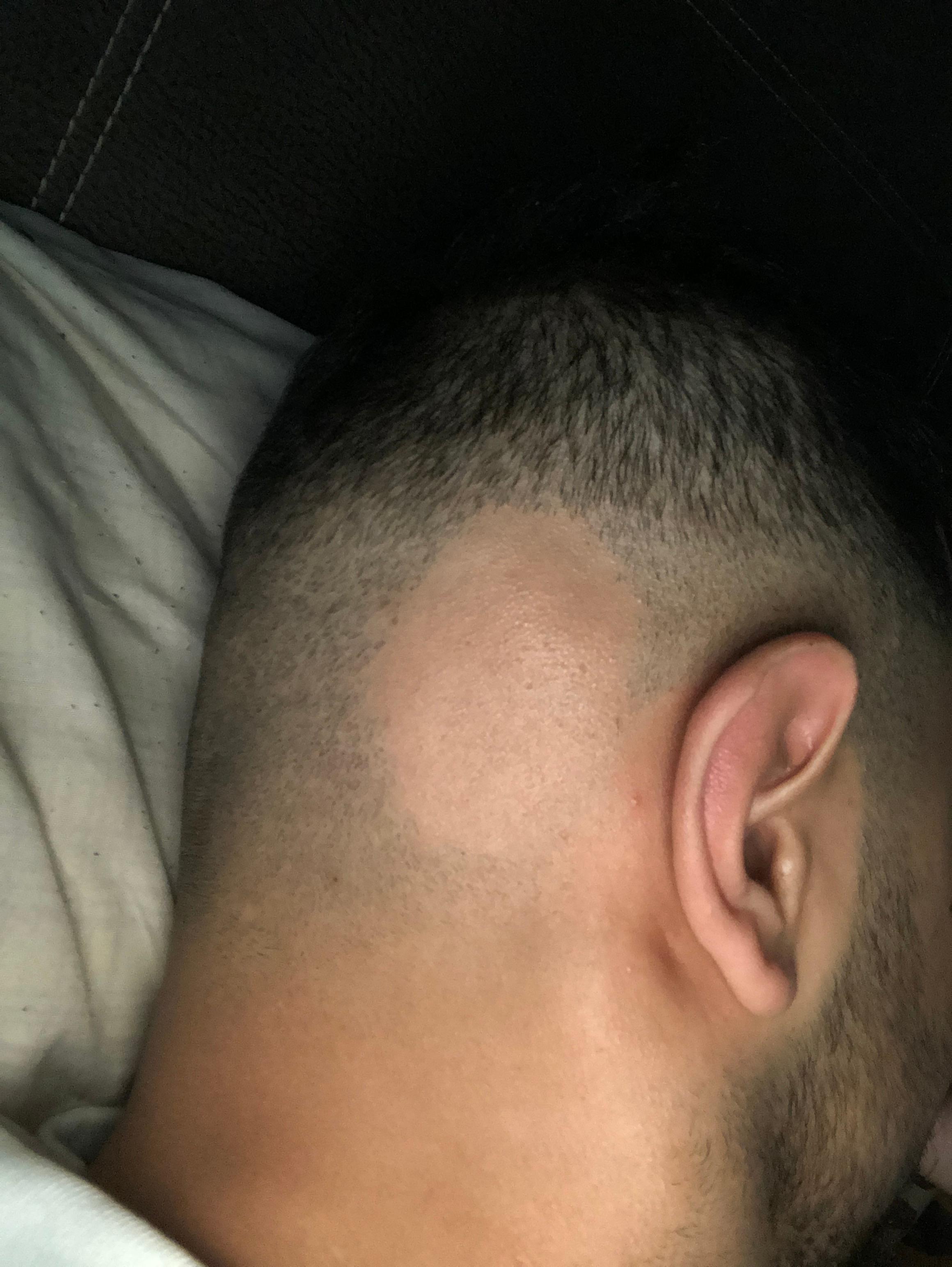 alopecia areata was kann man dagegen