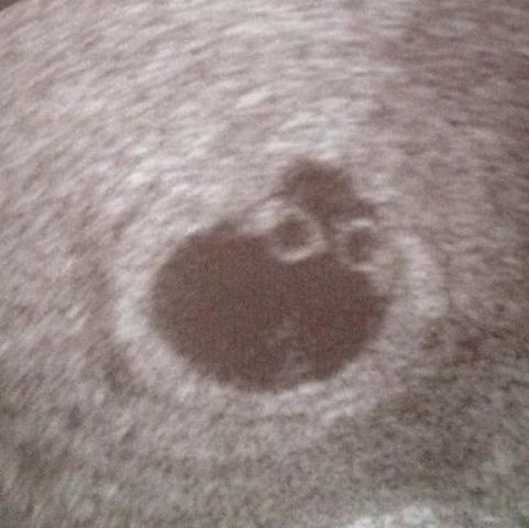 Hier ist das Ultraschall Bild von den Zwillingen  - (Kinder, Schwangerschaft, Baby)