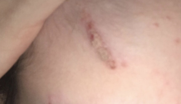 Alte Narbe Trocken Und Schuppig Gesundheit Und Medizin Haut Narben