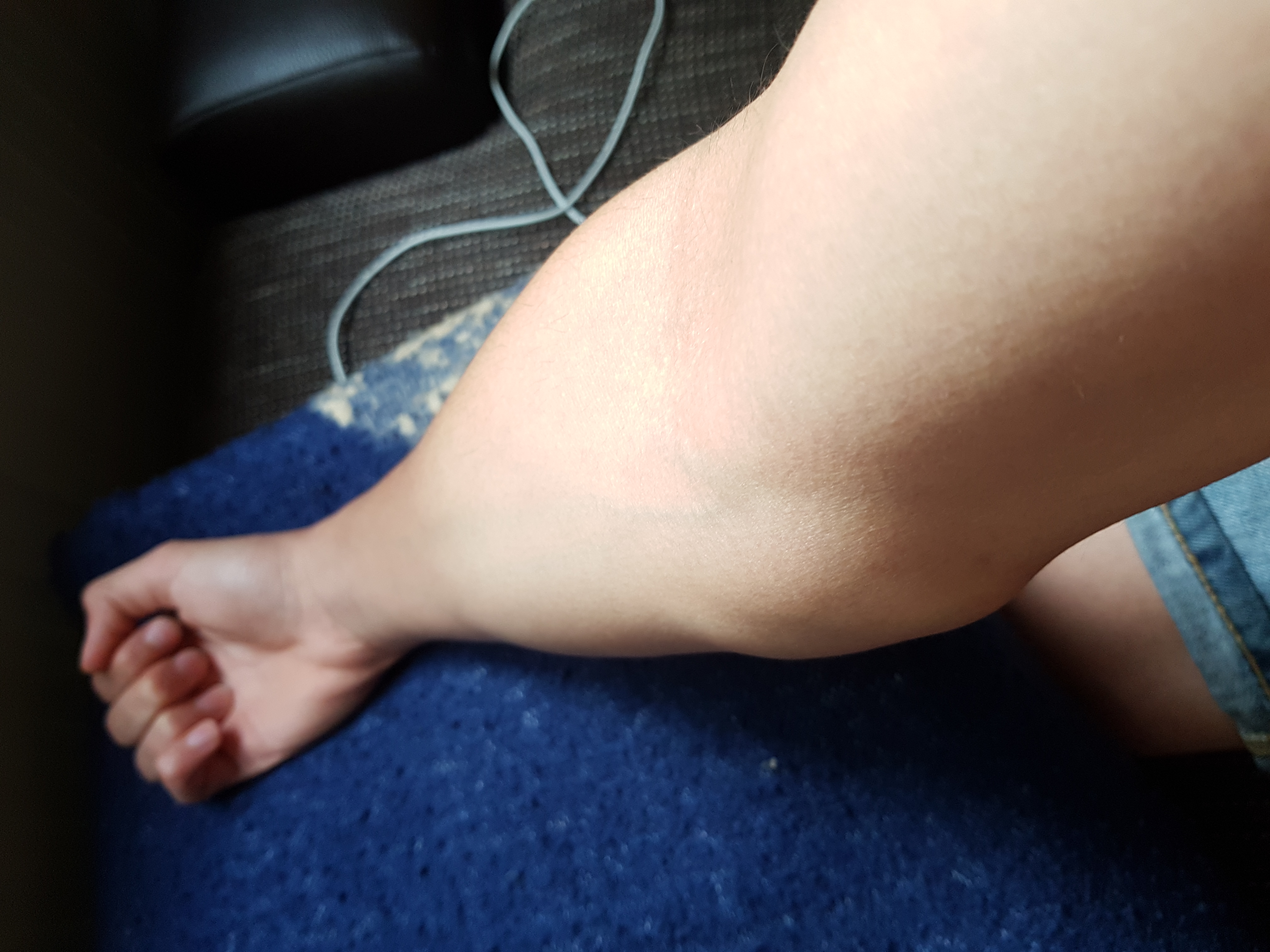 Am Ellenbogen Eine Schwellung An Der Linken Seite Gesundheit Und Medizin Sport Und Fitness Ellbogen Am Ellenbogen Eine Schwellung An Der Linken Seite Gesundheit Und Medizin Sport Und Fitness Ellbogen