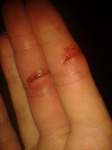 Am Finger Geschnitten Arzt Am Finger Geschnitten Arzt