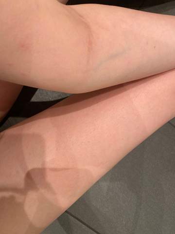 Am Ganzen Korper Starker Juckreiz Und Kleine Pickel Gesundheit Und Medizin