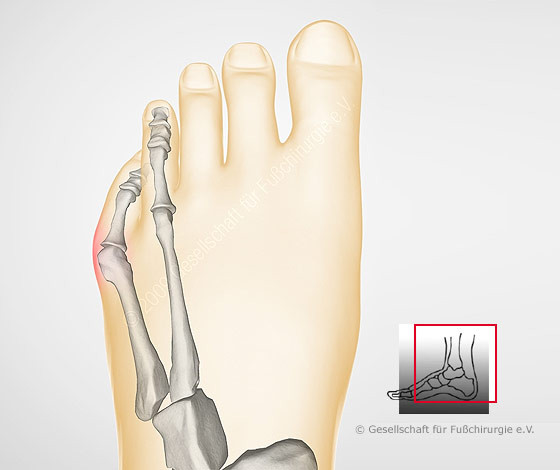 Am Kleinen Zeh Am Zehballen Schmerzen Gesundheit Fusse Orthopadie Am Kleinen Zeh Am Zehballen Schmerzen Gesundheit Fusse Orthopadie