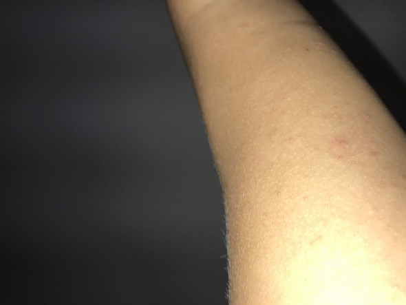 - (Haut, Pickel Rötung arm)