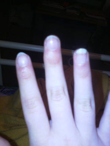 Am Rechtem Mittelfinger Eine Wolbung Komisch Am Rechtem Mittelfinger Eine Wolbung Komisch