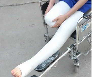 Bein gebrochen gips krücken