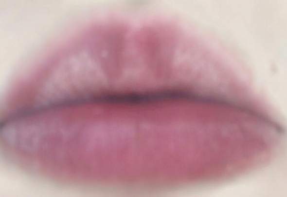 An Den Lippen Weisse Stellen Krankheit Lippe An Den Lippen Weisse Stellen Krankheit Lippe