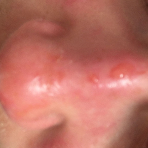 An Der Nase Wunde Vom Sonnenbrand Was Tun Medizin Beauty Haut An Der Nase Wunde Vom Sonnenbrand Was Tun Medizin Beauty Haut