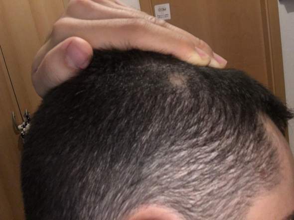 An Einer Kleinen Stelle Wachsen Keine Haare Mehr Kennt Jemand Das Problem Und Kann Mir Weiter Helfen Medizin Haut Haarausfall