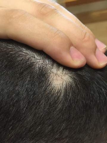 An Einer Kleinen Stelle Wachsen Keine Haare Mehr Kennt Jemand Das Problem Und Kann Mir Weiter Helfen Medizin Haut Haarausfall