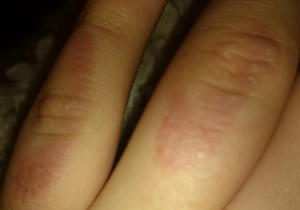Meine Hand nach zwei Tagen - (Hand, Verbrennung)