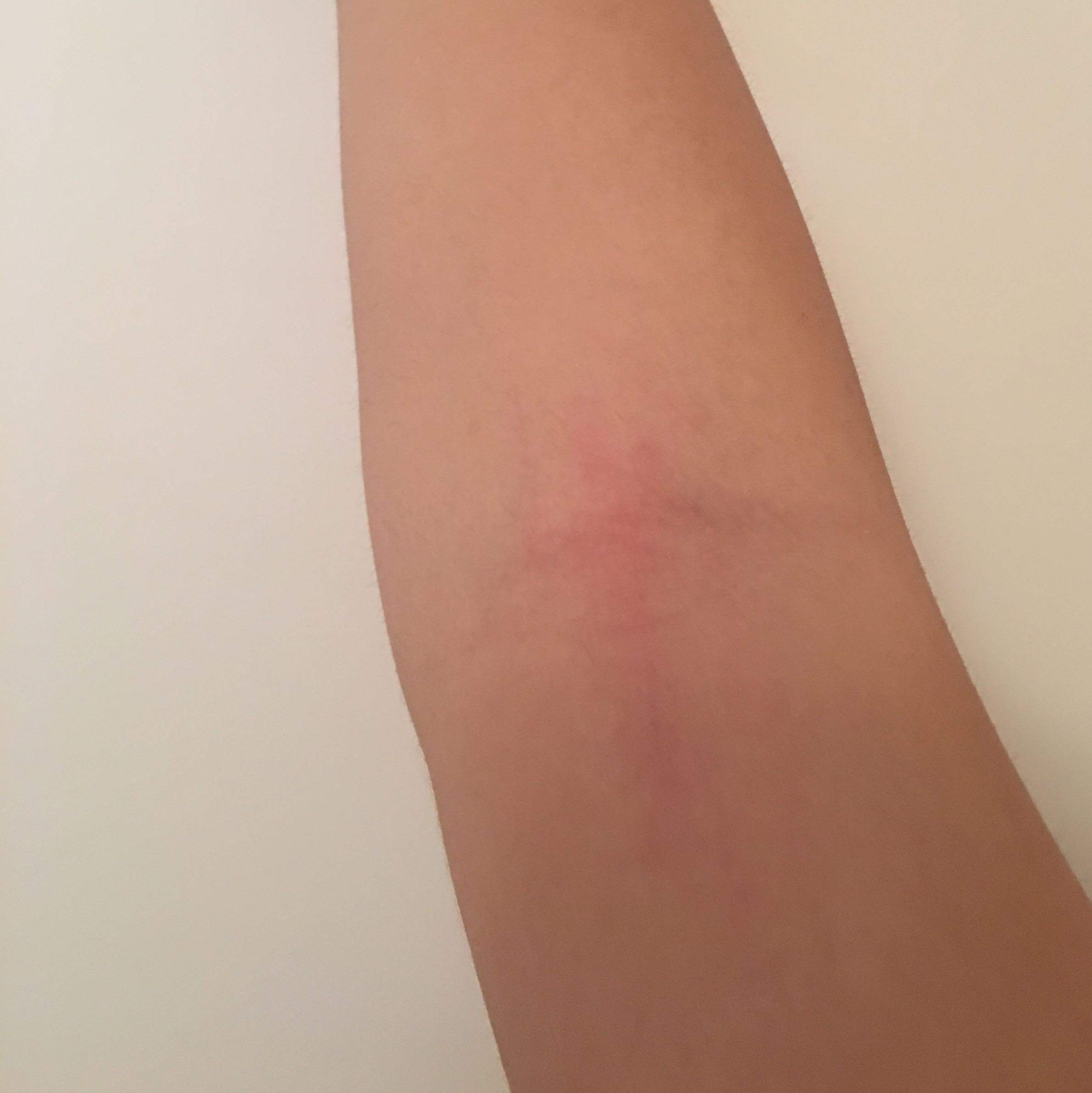 Anfang Einer Blutvergiftung Arm Anfang Einer Blutvergiftung Arm