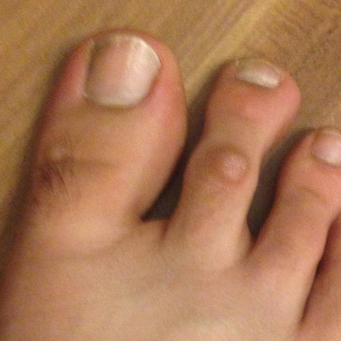 Anfangs Dachte Ich Dass Dies Blasen Sind Aber Die Gehen Einfach Nicht Weg Arzt Artz Anfangs Dachte Ich Dass Dies Blasen Sind Aber Die Gehen Einfach Nicht Weg Arzt Artz