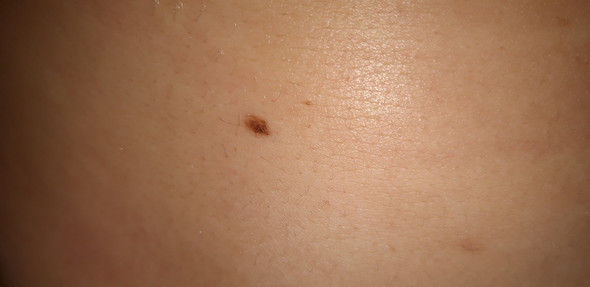 Anfangsstadium Schwarzer Hautkrebs Gesundheit Und Medizin Gesundheit Haut Anfangsstadium Schwarzer Hautkrebs Gesundheit Und Medizin Gesundheit Haut