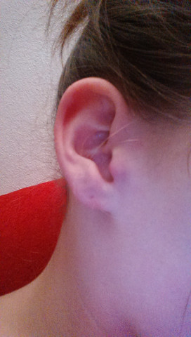 Angeschwollener Tragus Der Schmerzt Schmerzen Ohr Hno Angeschwollener Tragus Der Schmerzt Schmerzen Ohr Hno