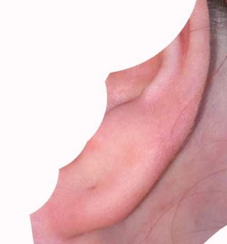 Angeschwollenes Ohrloch? (Piercing, Entzündung, Ohr)